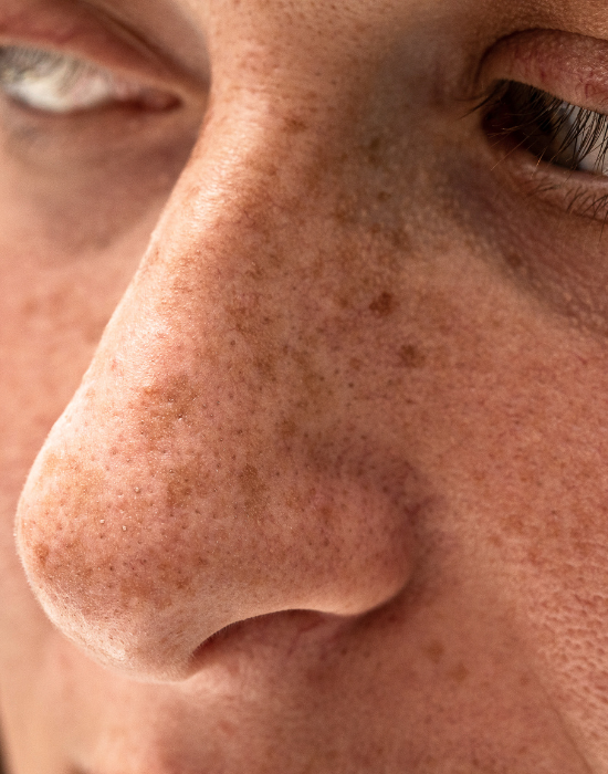 Sun Damage