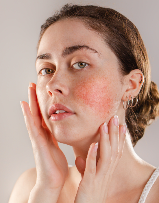 Rosacea