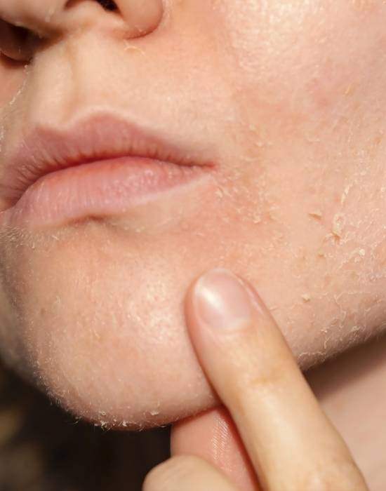 Dry Skin
