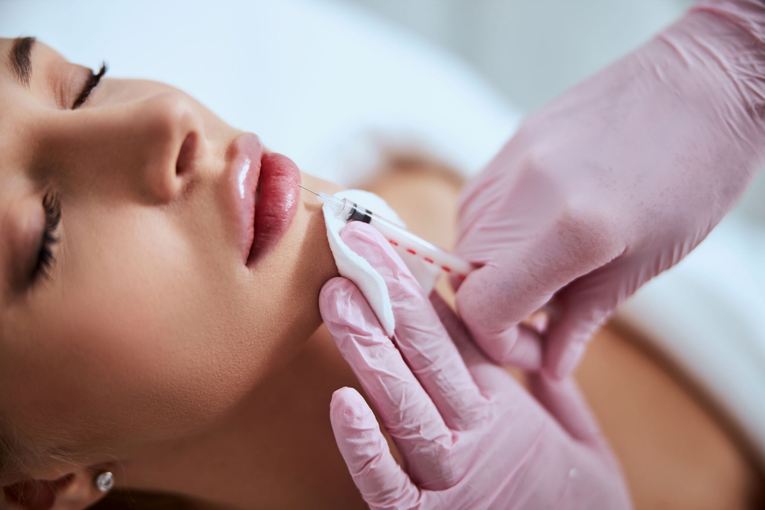 What to Expect After Lip Fillers